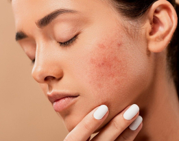 L'acné chez l'adulte, plus fréquent que l'on ne le pense
