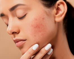 L'acné chez l'adulte, plus fréquent que l'on ne le pense